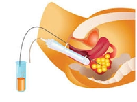 Aşılama Yöntemleri Nelerdir?