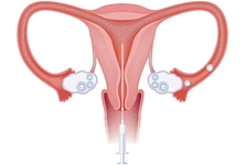 Aşılama Türleri ve Özellikleri